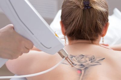 Laser Tattoo Removal | Sparrow Insurance